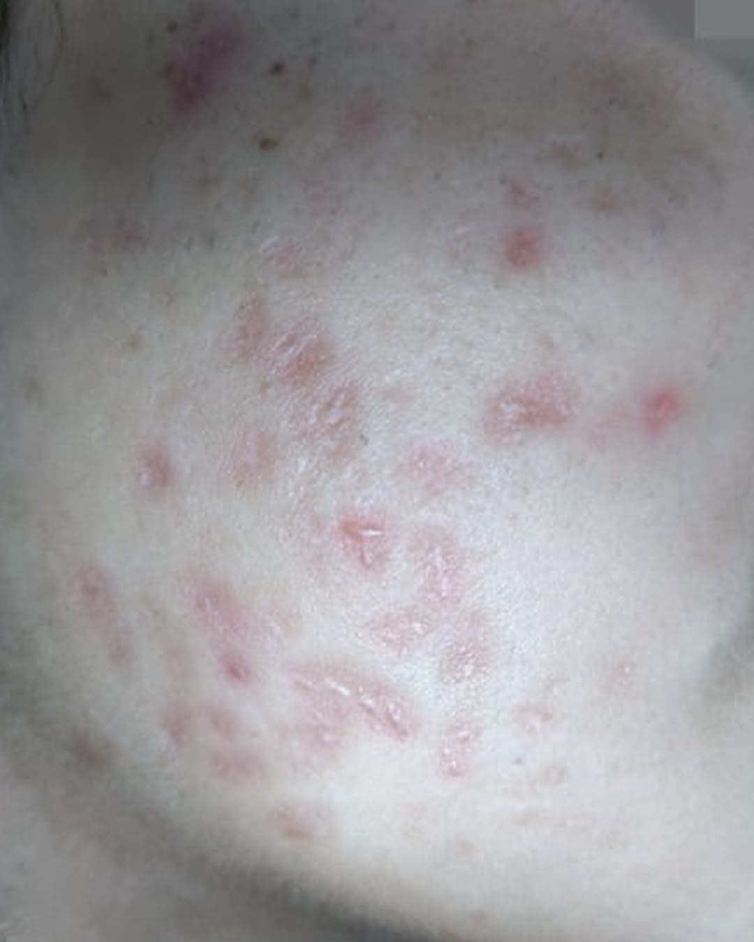After treatment