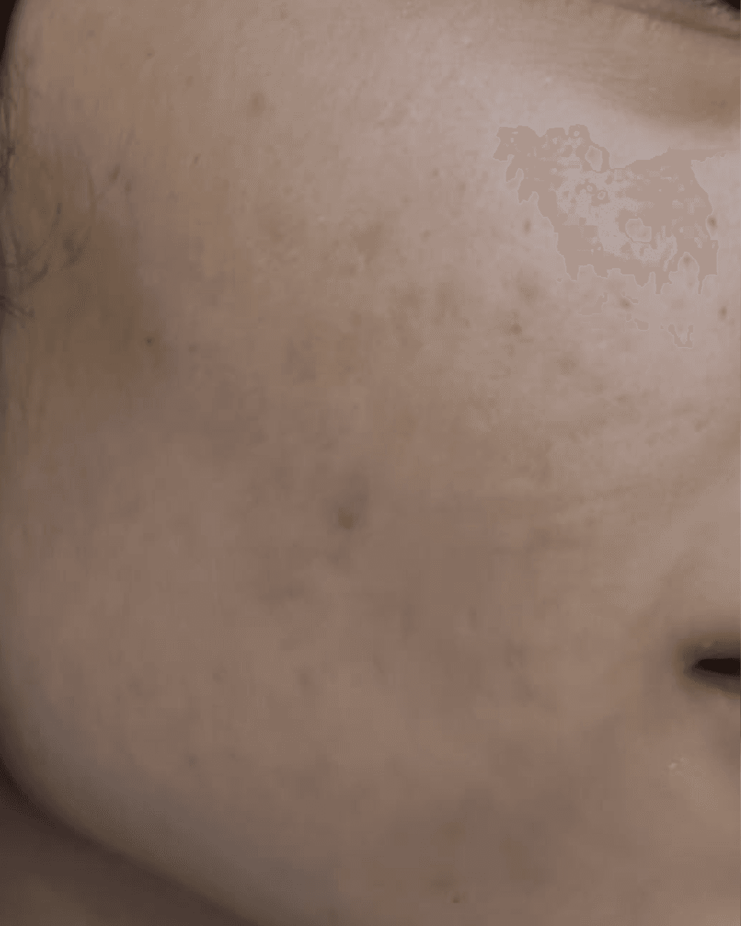 Before treatment