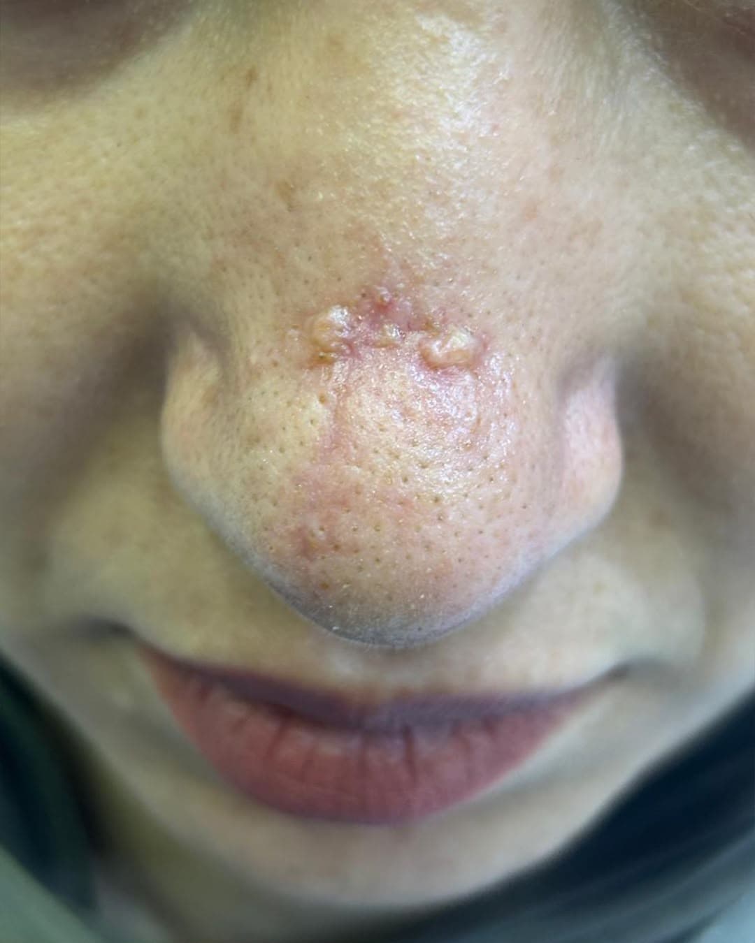 After treatment