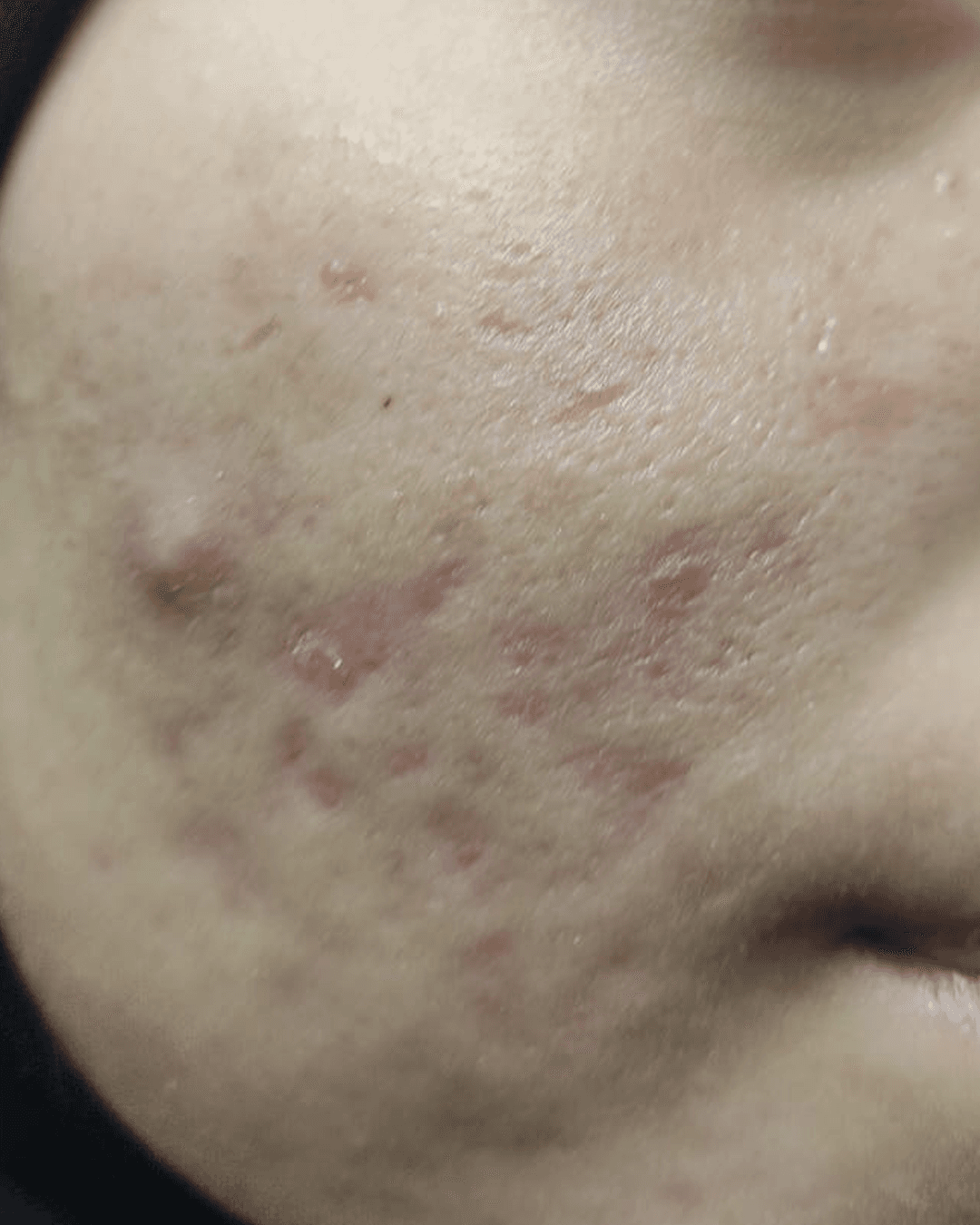 After treatment