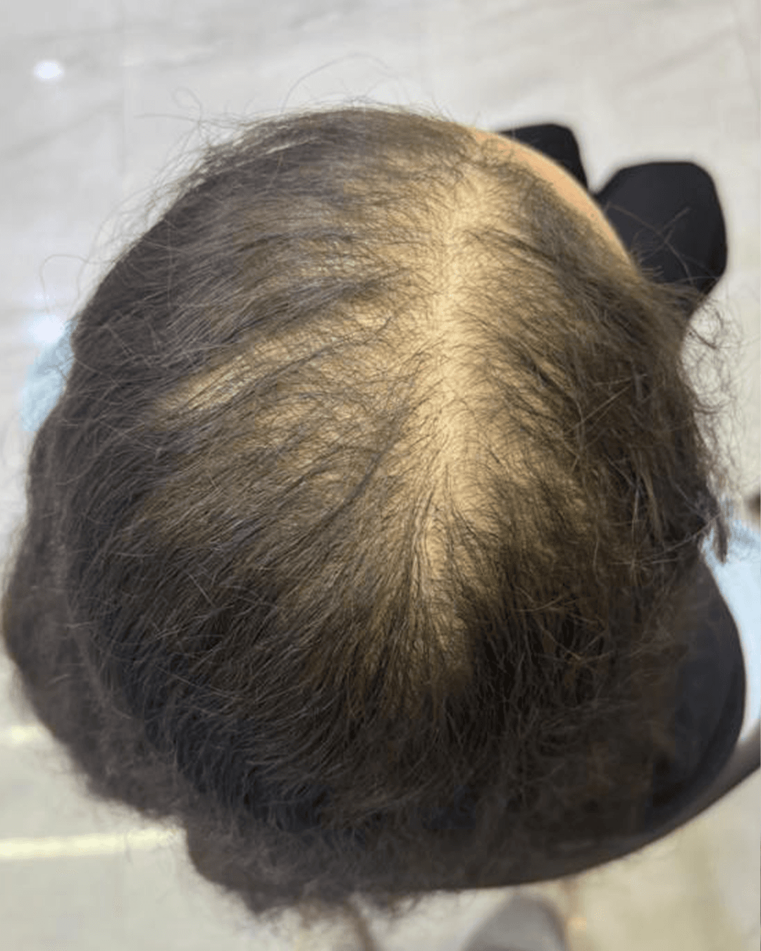 Before treatment