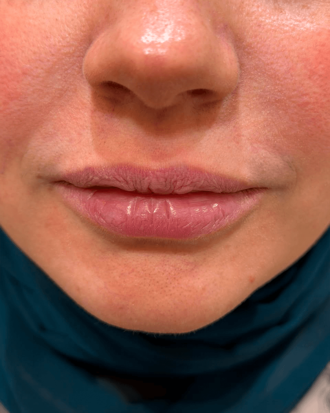 After treatment