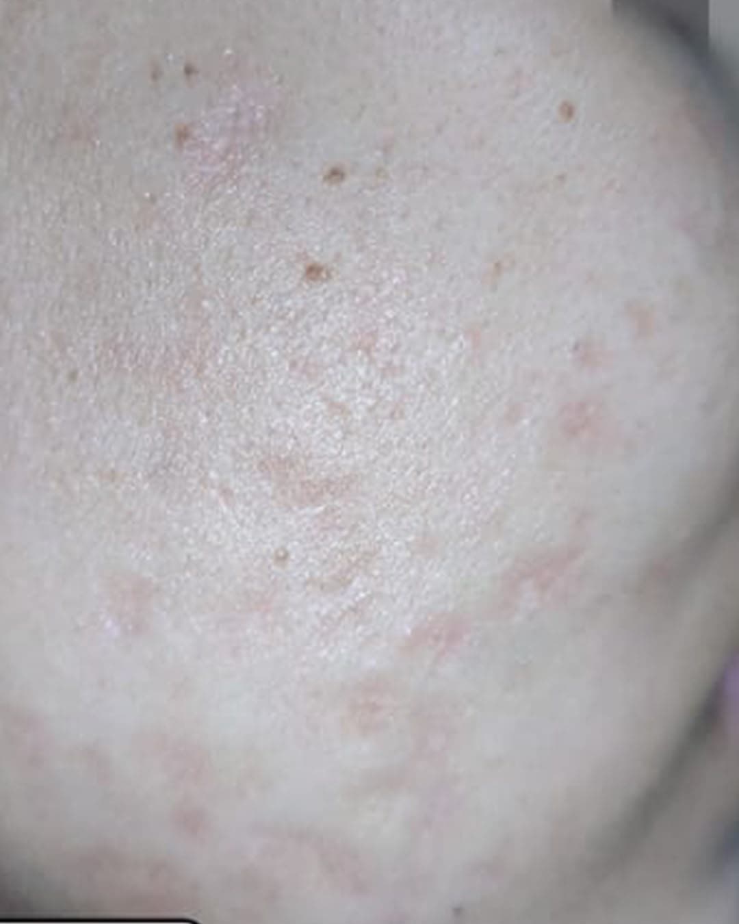 Before treatment