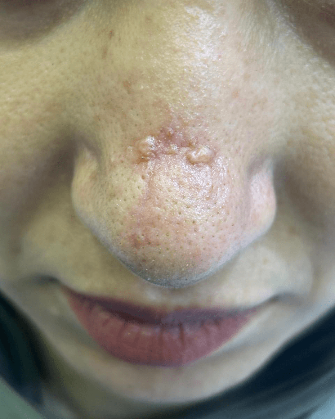 After treatment