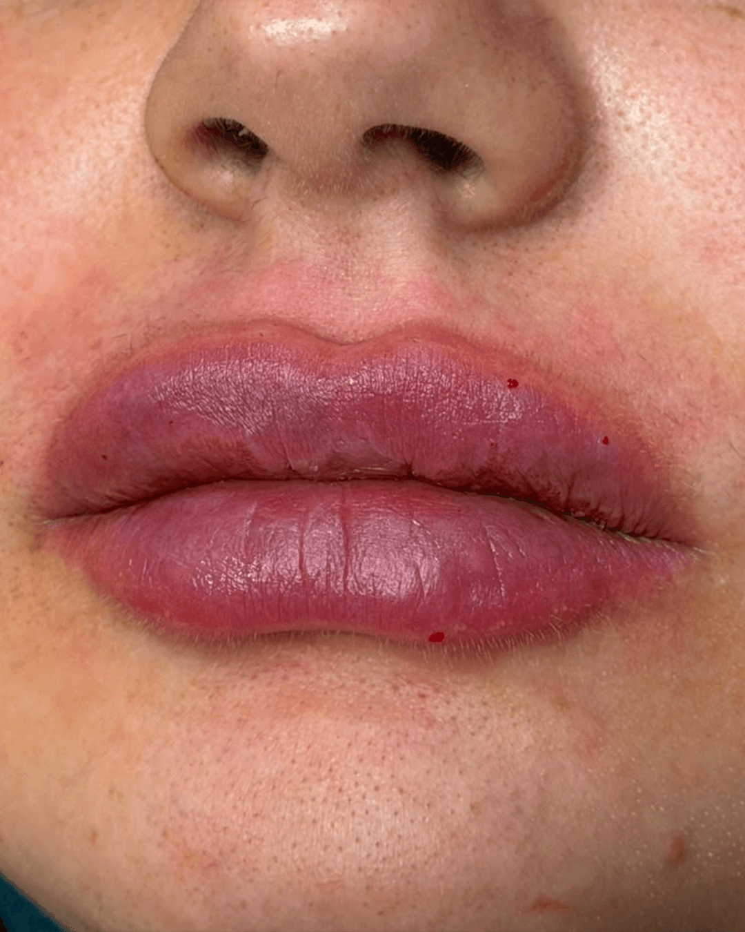 Before treatment